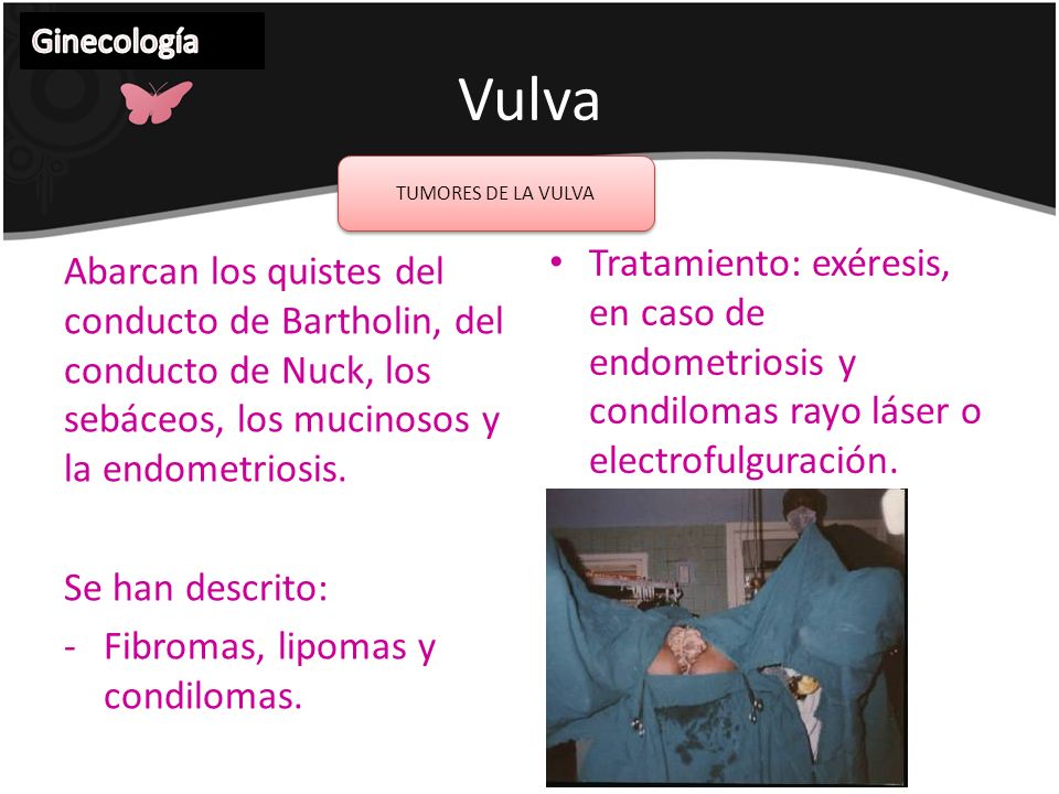 Ginecología Vulva. TUMORES DE LA VULVA. Tratamiento: exéresis, en caso de endometriosis y condilomas rayo láser o electrofulguración.