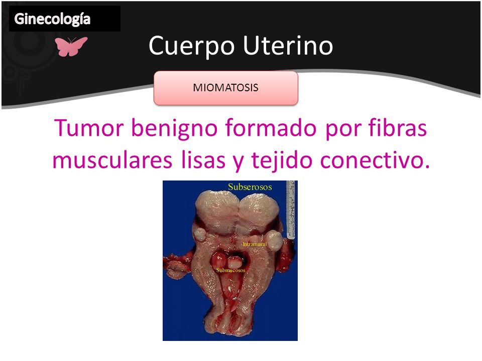 Tumor benigno formado por fibras musculares lisas y tejido conectivo.