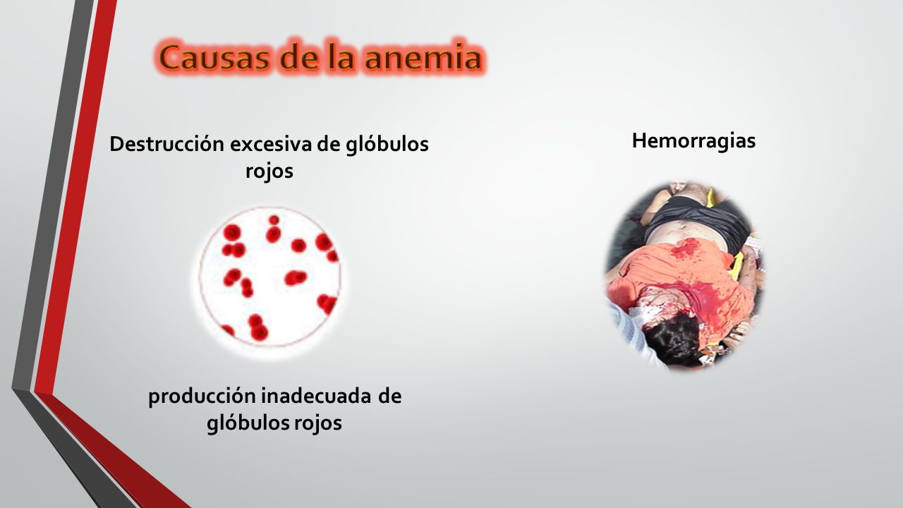 Causas de la anemia Hemorragias Destrucción excesiva de glóbulos rojos