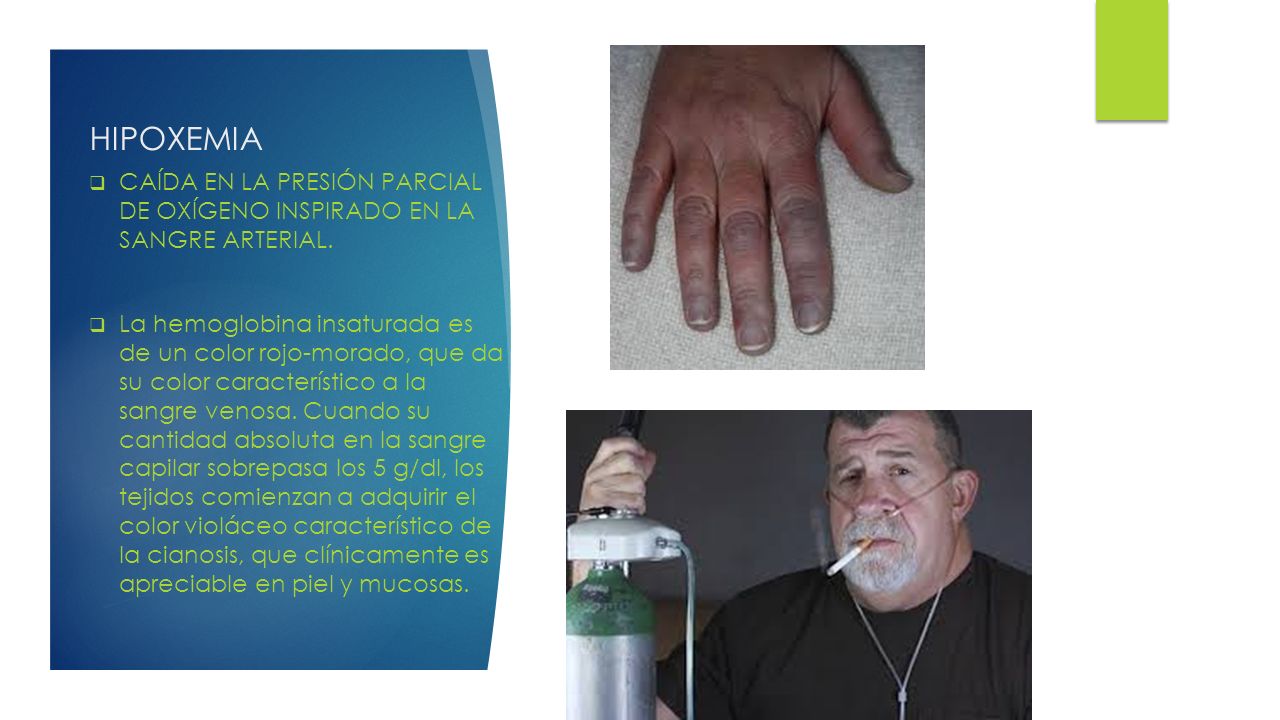 HIPOXEMIA CAÍDA EN LA PRESIÓN PARCIAL DE OXÍGENO INSPIRADO EN LA SANGRE ARTERIAL.