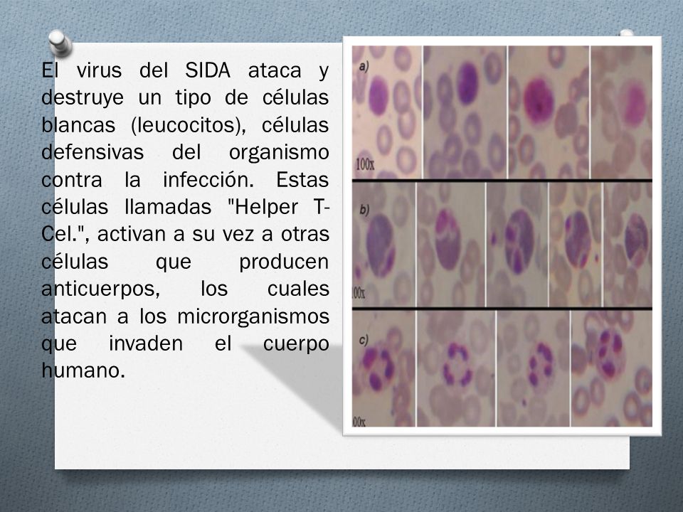 El virus del SIDA ataca y destruye un tipo de células blancas (leucocitos), células defensivas del organismo contra la infección.