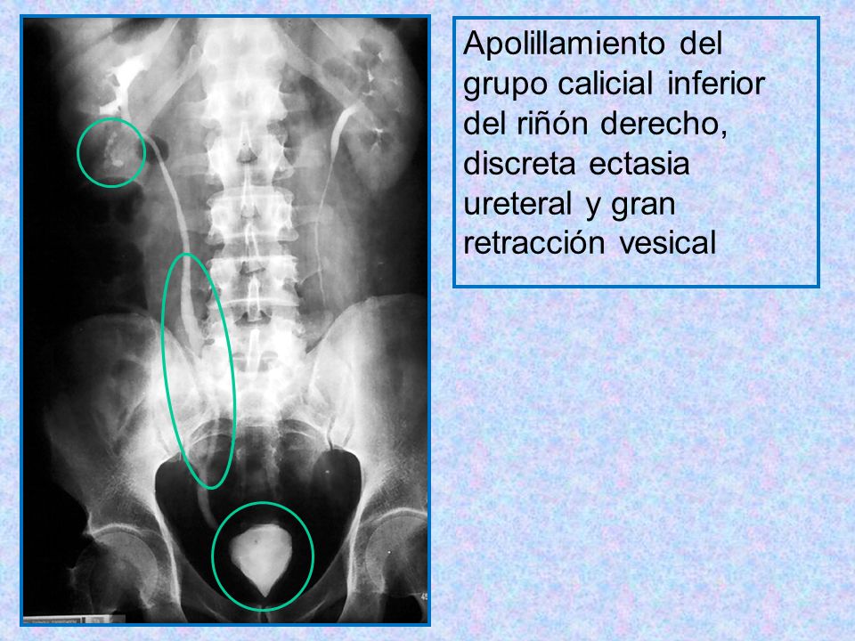 Apolillamiento del grupo calicial inferior. del riñón derecho, discreta ectasia. ureteral y gran.