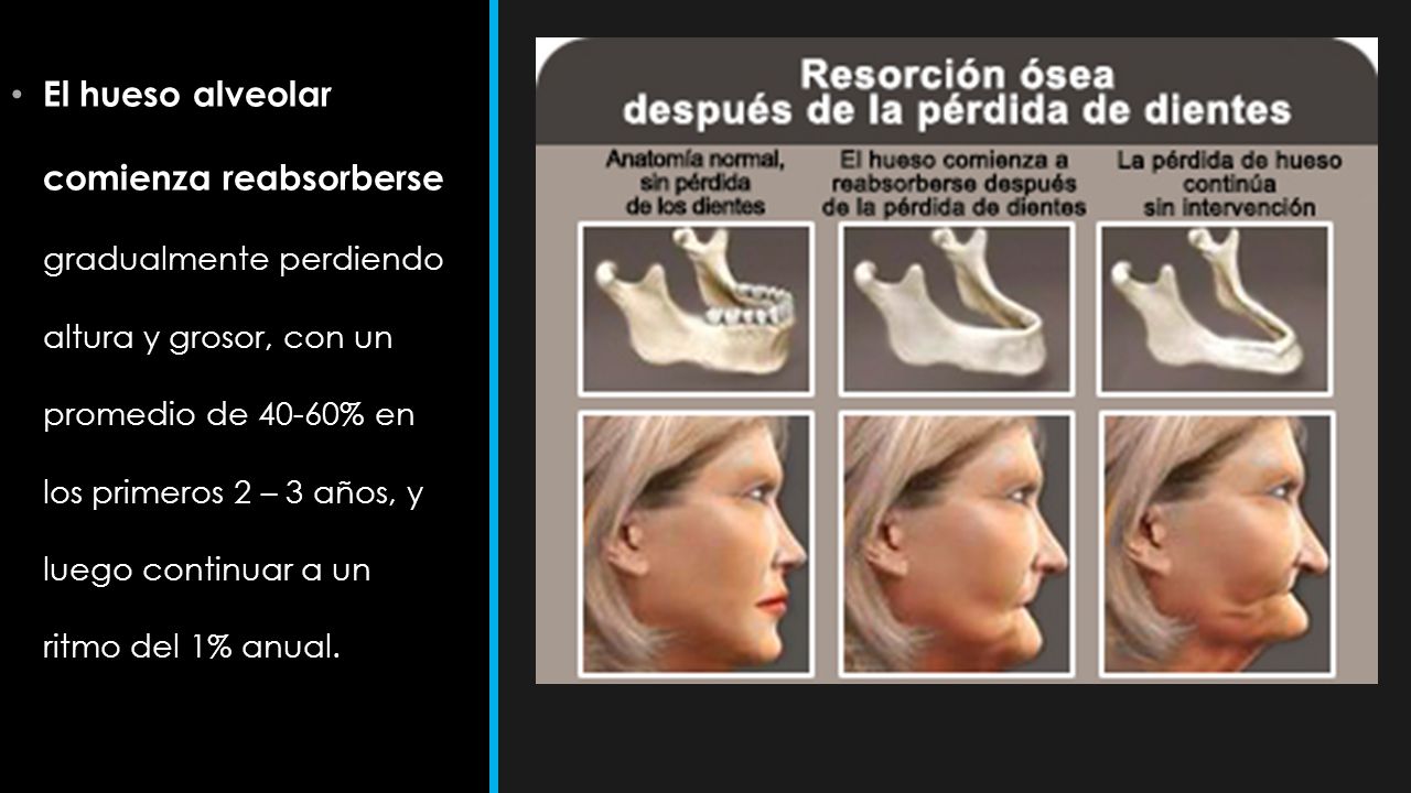 El hueso alveolar comienza reabsorberse gradualmente perdiendo altura y grosor, con un promedio de 40-60% en los primeros 2 – 3 años, y luego continuar a un ritmo del 1% anual.