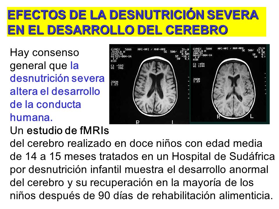 EFECTOS DE LA DESNUTRICIÓN SEVERA EN EL DESARROLLO DEL CEREBRO