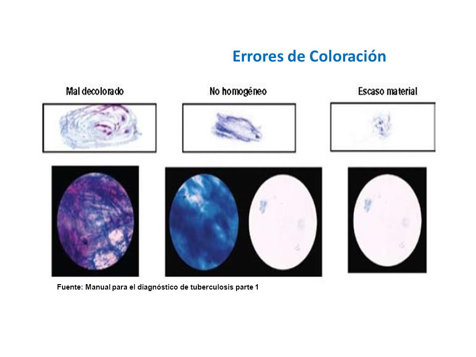 Errores de Coloración Fuente: Manual para el diagnóstico de tuberculosis parte 1
