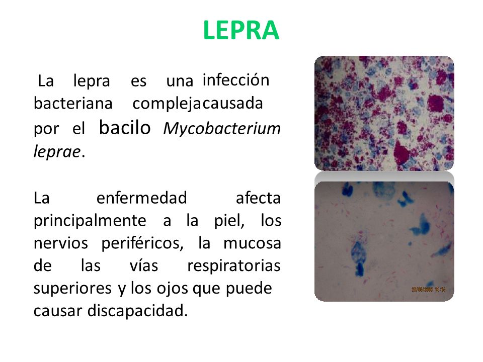 LEPRA bacilo La lepra es una bacteriana compleja por el Mycobacterium