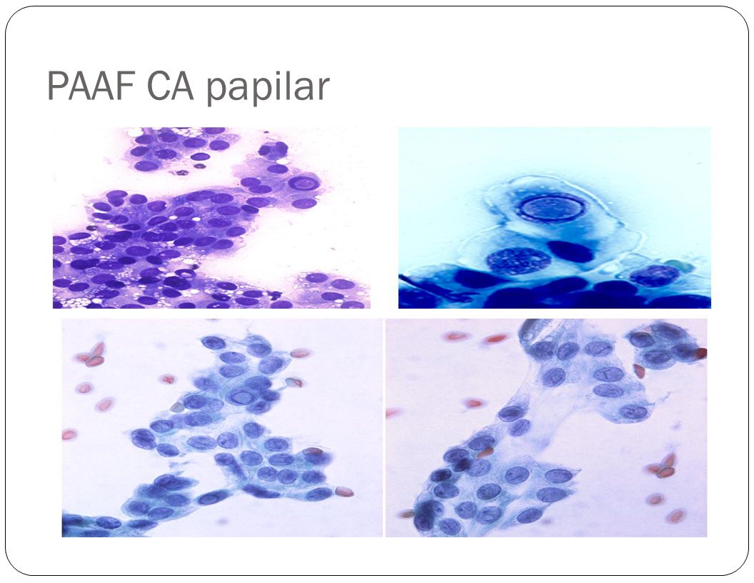 PAAF CA papilar