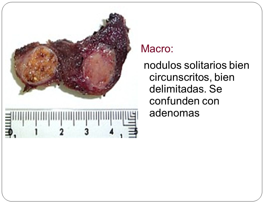 Macro: nodulos solitarios bien circunscritos, bien delimitadas. Se confunden con adenomas