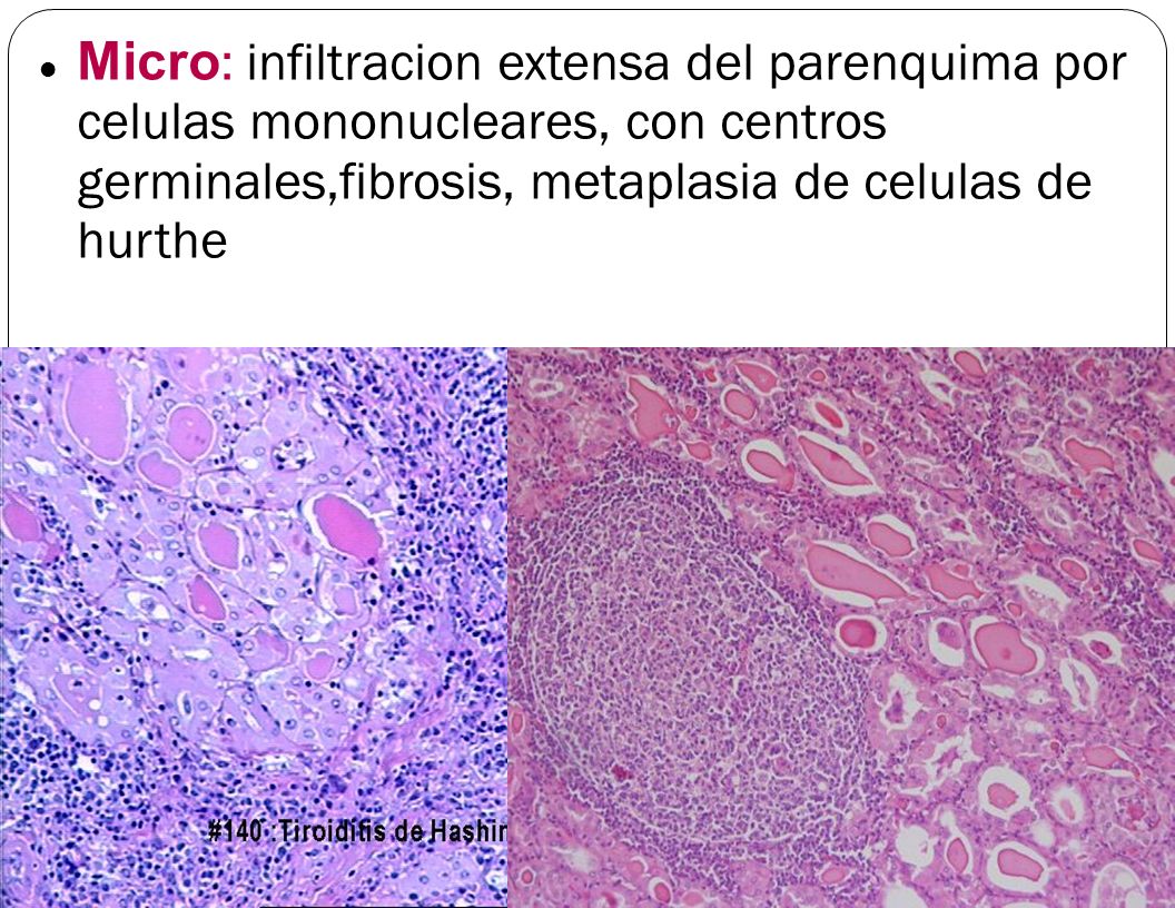 Micro: infiltracion extensa del parenquima por celulas mononucleares, con centros germinales,fibrosis, metaplasia de celulas de hurthe
