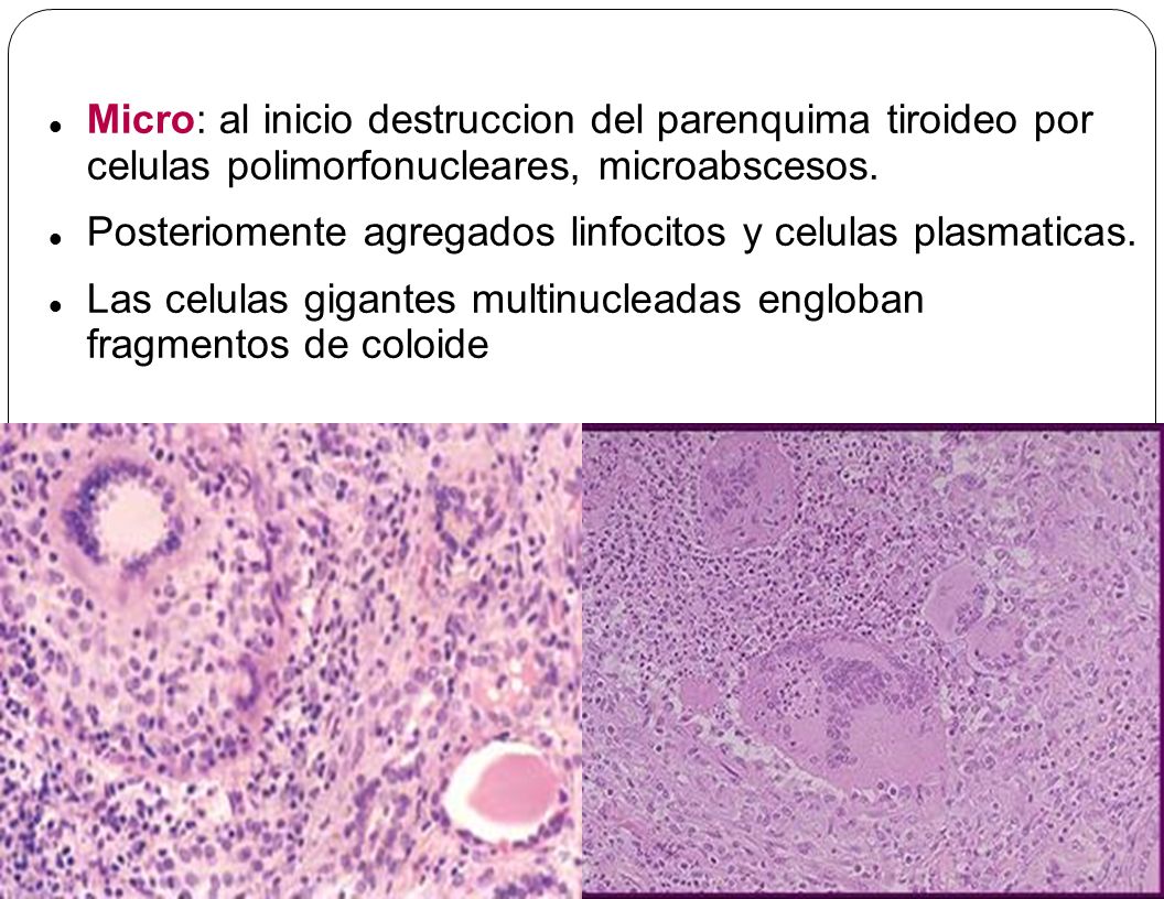 Micro: al inicio destruccion del parenquima tiroideo por celulas polimorfonucleares, microabscesos.