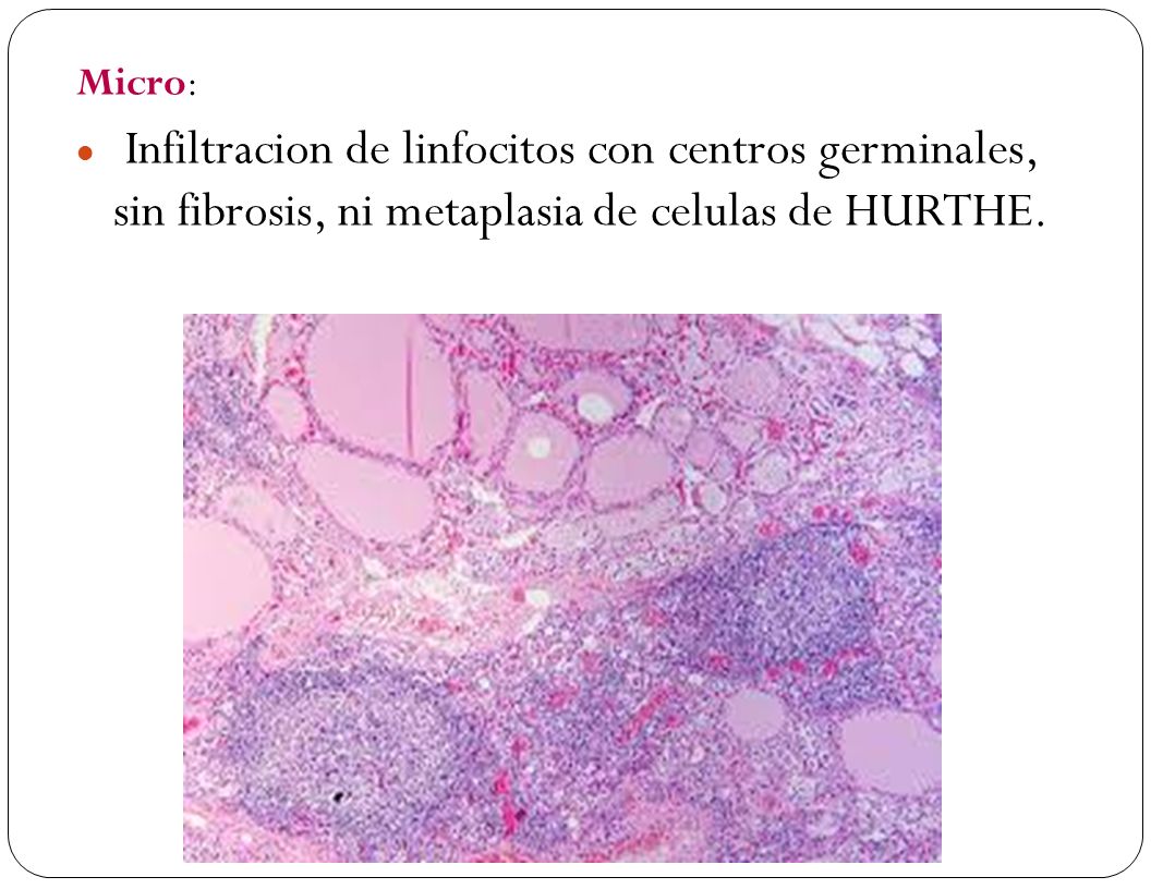 Micro: Infiltracion de linfocitos con centros germinales, sin fibrosis, ni metaplasia de celulas de HURTHE.
