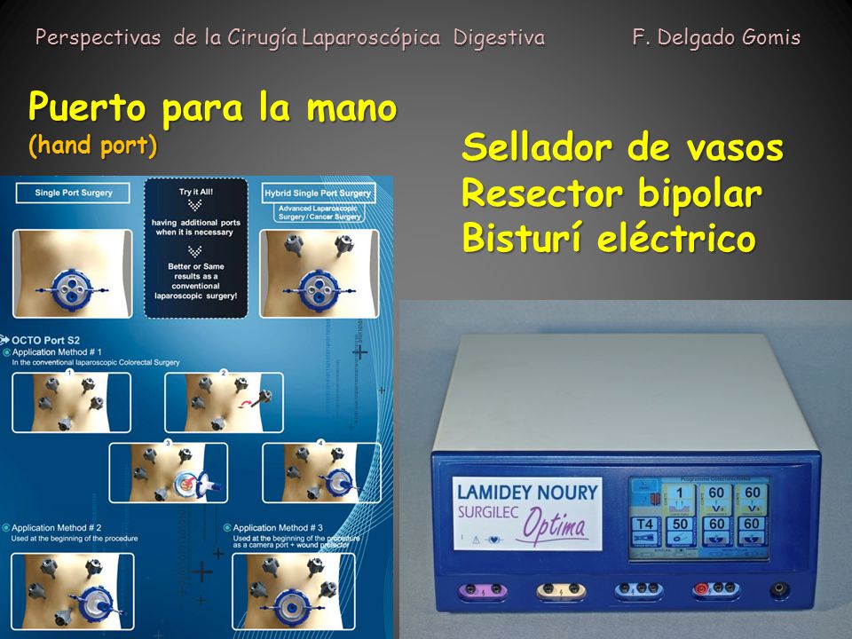 Puerto para la mano Sellador de vasos Resector bipolar