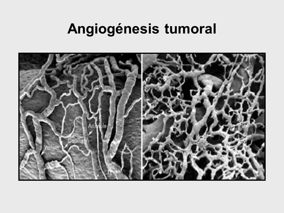 Angiogénesis tumoral
