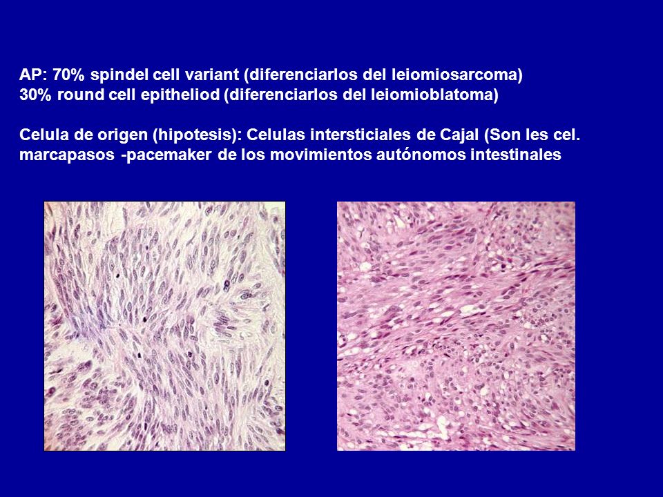 AP: 70% spindel cell variant (diferenciarlos del leiomiosarcoma)