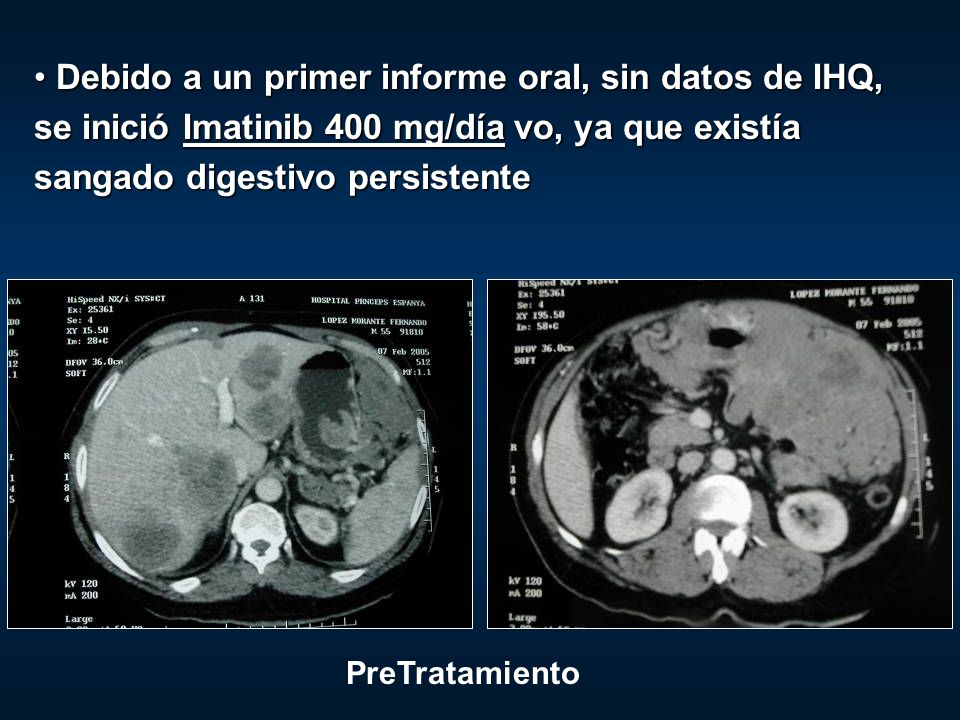 Debido a un primer informe oral, sin datos de IHQ, se inició Imatinib 400 mg/día vo, ya que existía sangado digestivo persistente