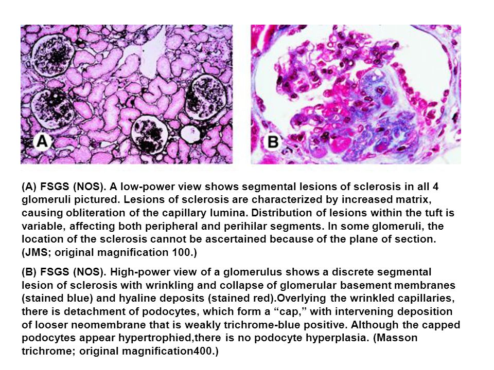 (A) FSGS (NOS). A low-power view shows segmental lesions of sclerosis in all 4 glomeruli pictured. Lesions of sclerosis are characterized by increased matrix, causing obliteration of the capillary lumina. Distribution of lesions within the tuft is variable, affecting both peripheral and perihilar segments. In some glomeruli, the location of the sclerosis cannot be ascertained because of the plane of section. (JMS; original magnification 100.)