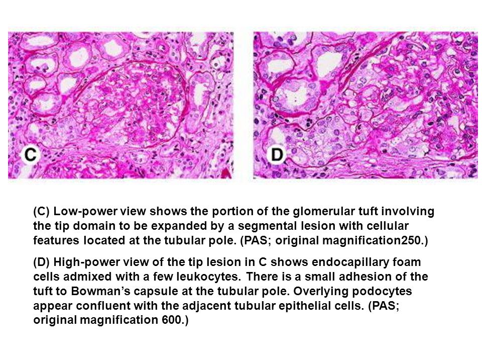 (C) Low-power view shows the portion of the glomerular tuft involving the tip domain to be expanded by a segmental lesion with cellular features located at the tubular pole. (PAS; original magnification250.)