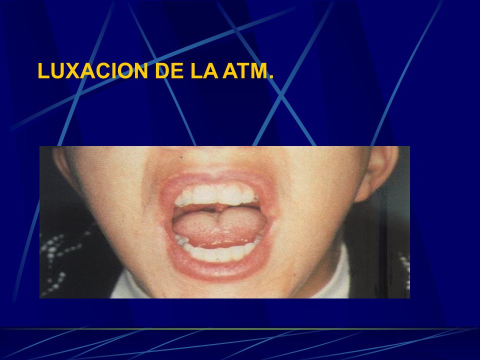 LUXACION DE LA ATM. La luxación de la ATM puede ser motivada por diferentes causas entre las que mencionaremos solamente algunas: