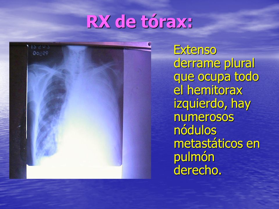 RX de tórax: Extenso derrame plural que ocupa todo el hemitorax izquierdo, hay numerosos nódulos metastáticos en pulmón derecho.