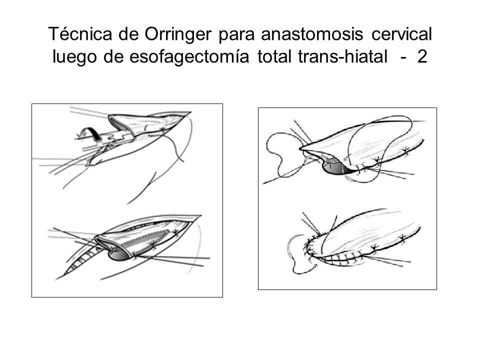 Técnica de Orringer para anastomosis cervical luego de esofagectomía total trans-hiatal - 2