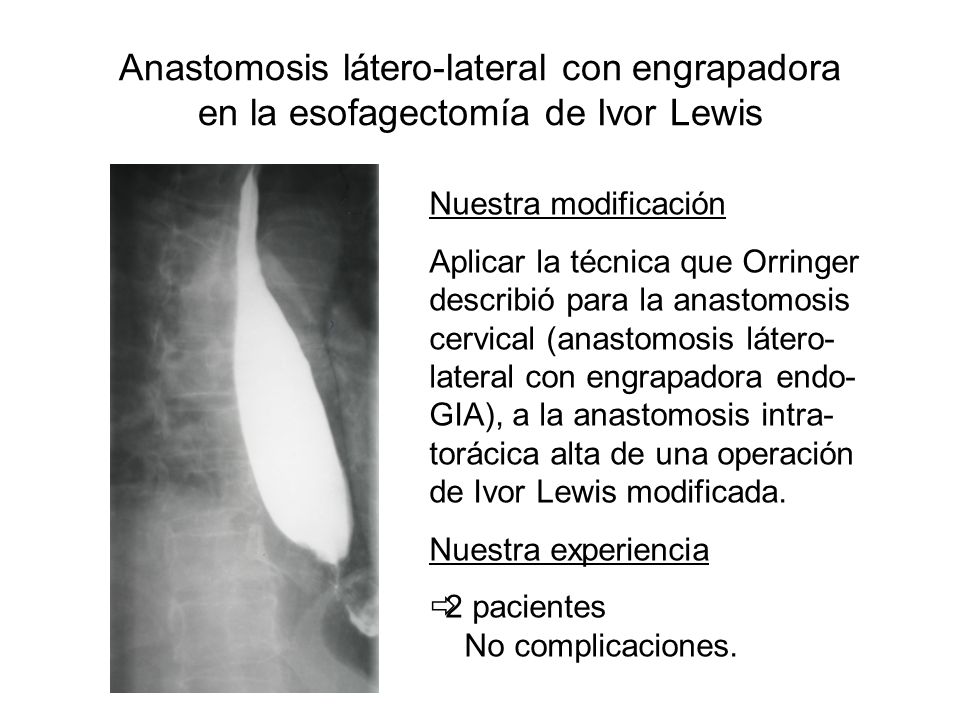 Anastomosis látero-lateral con engrapadora en la esofagectomía de Ivor Lewis