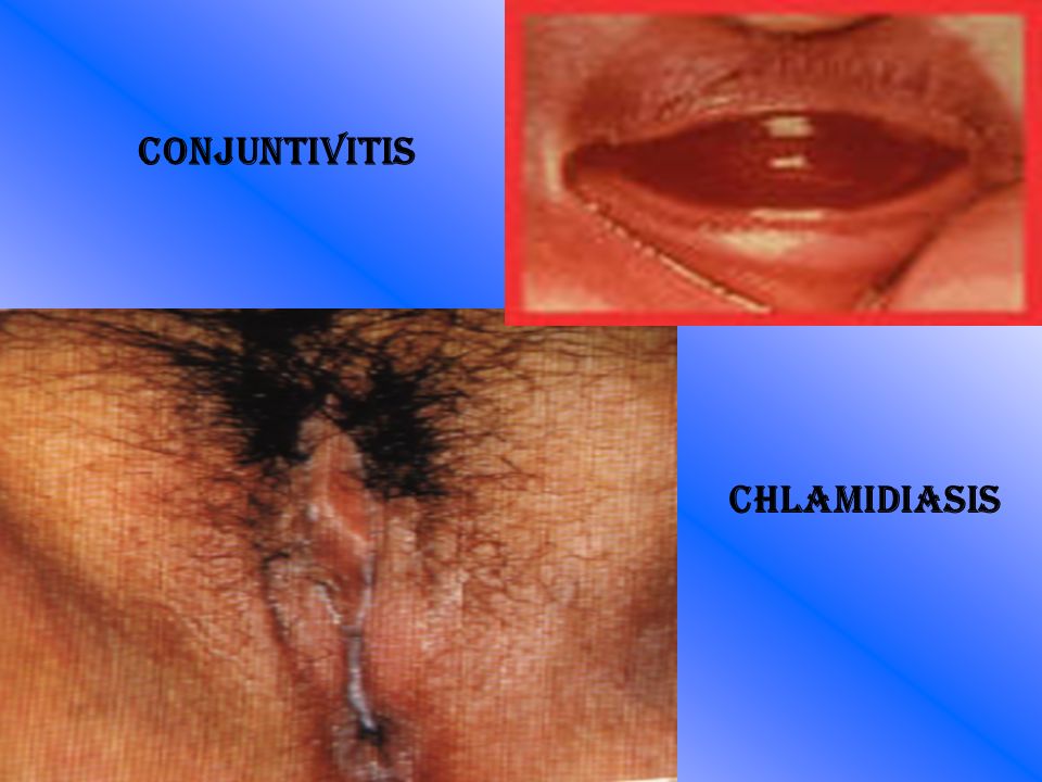 Conjuntivitis Chlamidiasis