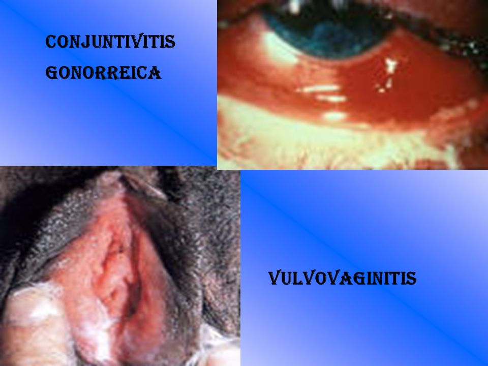 Conjuntivitis gonorreica Vulvovaginitis