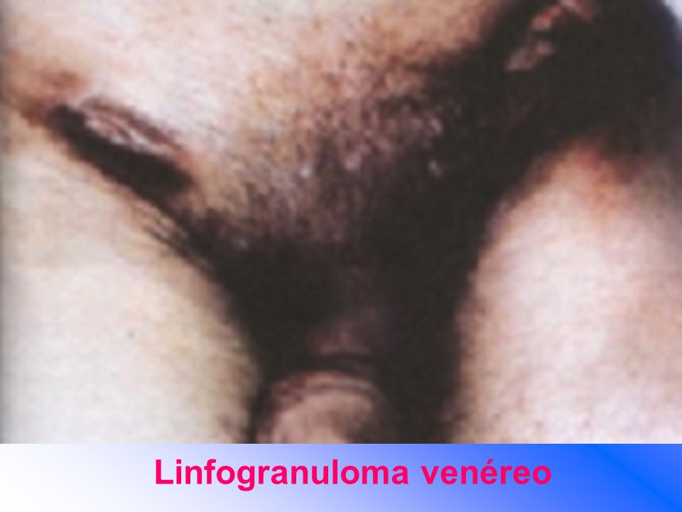 Linfogranuloma venéreo