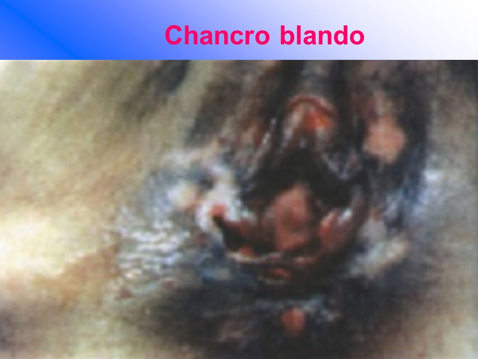 Chancro blando