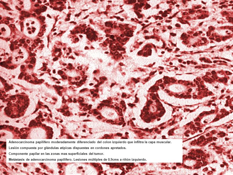 Adenocarcinoma papilifero moderadamente diferenciado del colon izquierdo que infiltra la capa muscular.