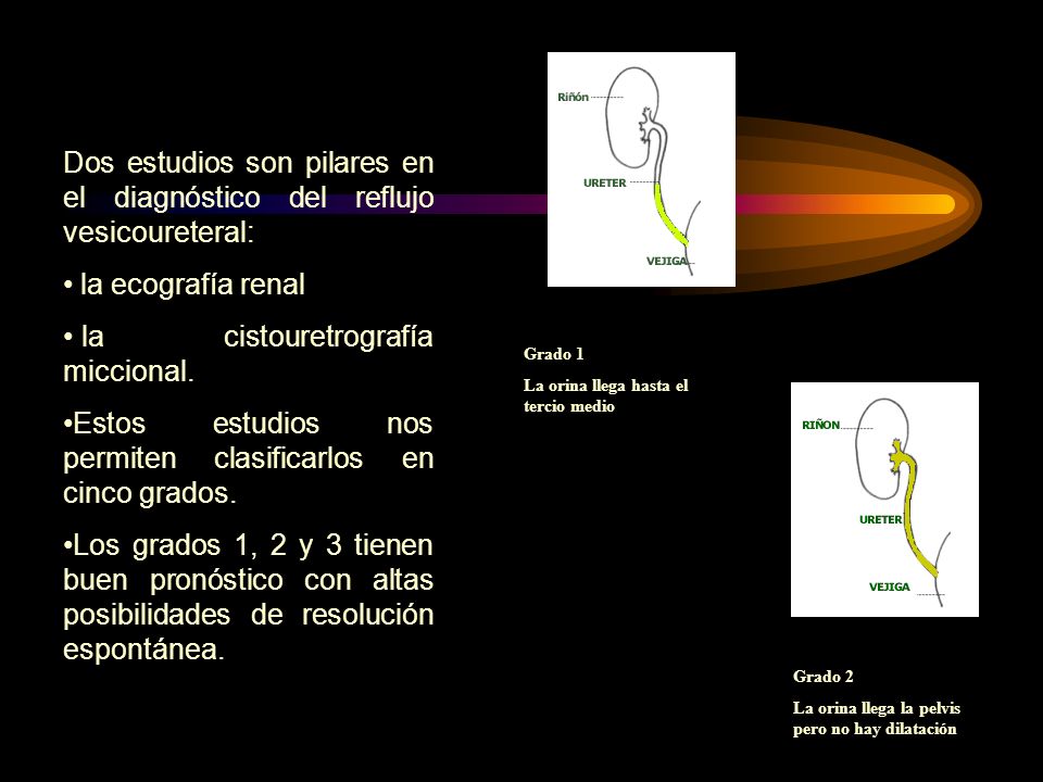 Dos estudios son pilares en el diagnóstico del reflujo vesicoureteral:
