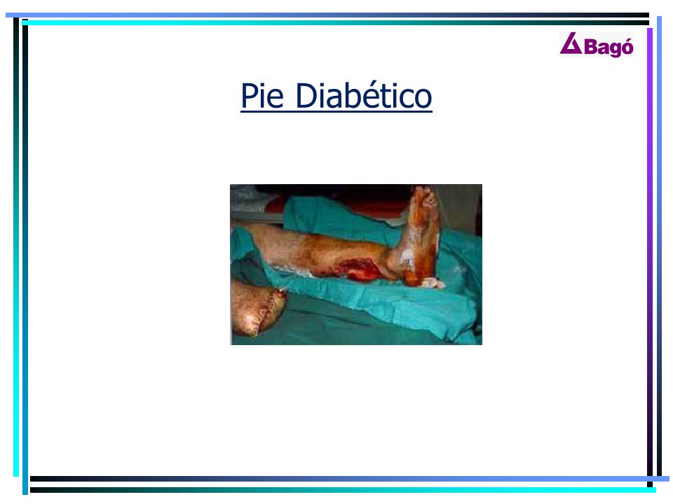 Pie Diabético