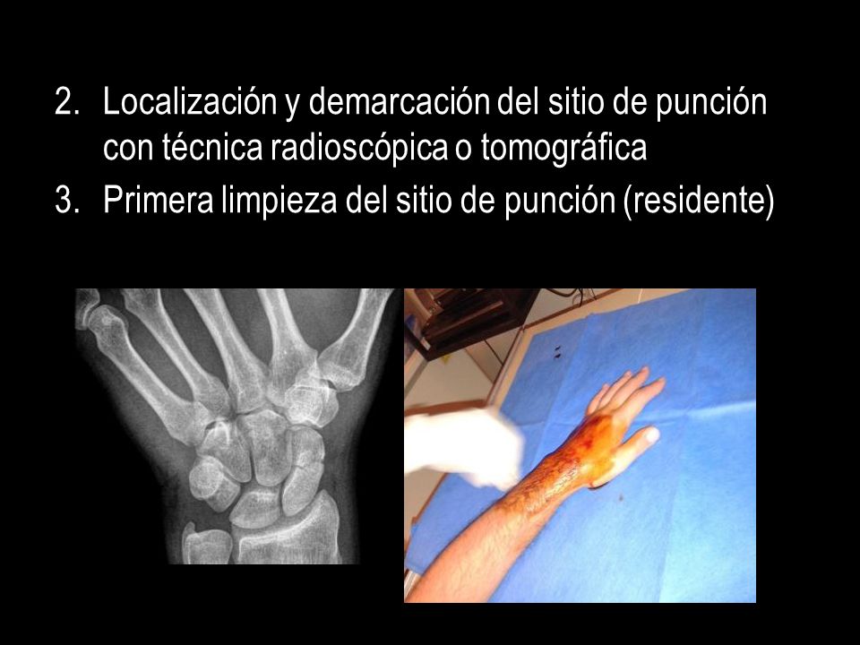 Localización y demarcación del sitio de punción con técnica radioscópica o tomográfica