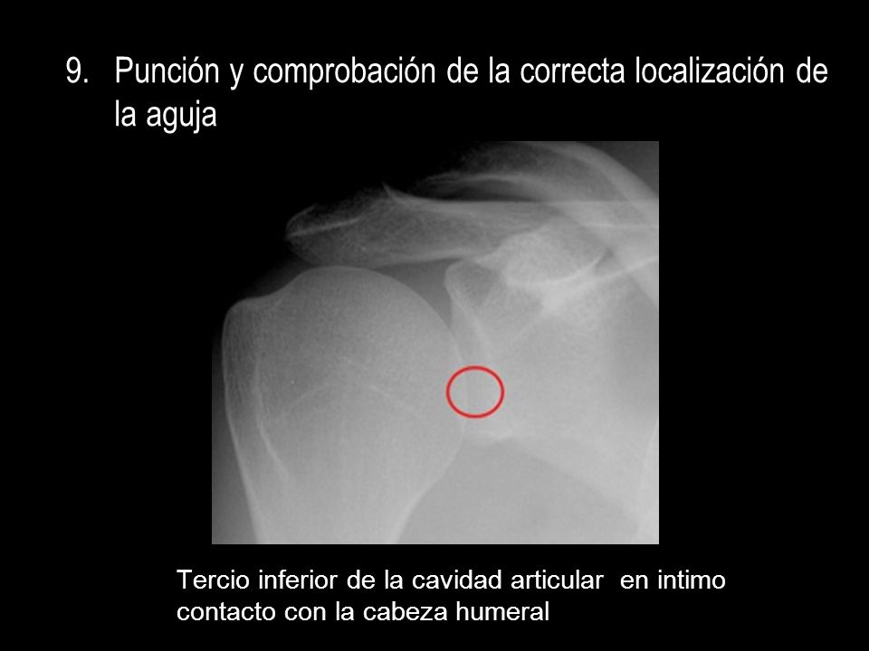 Punción y comprobación de la correcta localización de la aguja