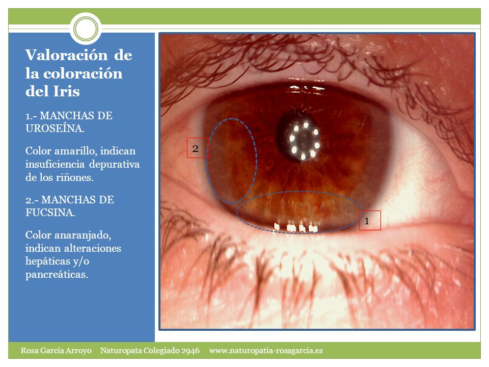 Valoración de la coloración del Iris