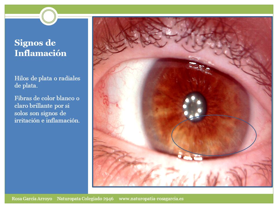 Signos de Inflamación Hilos de plata o radiales de plata.