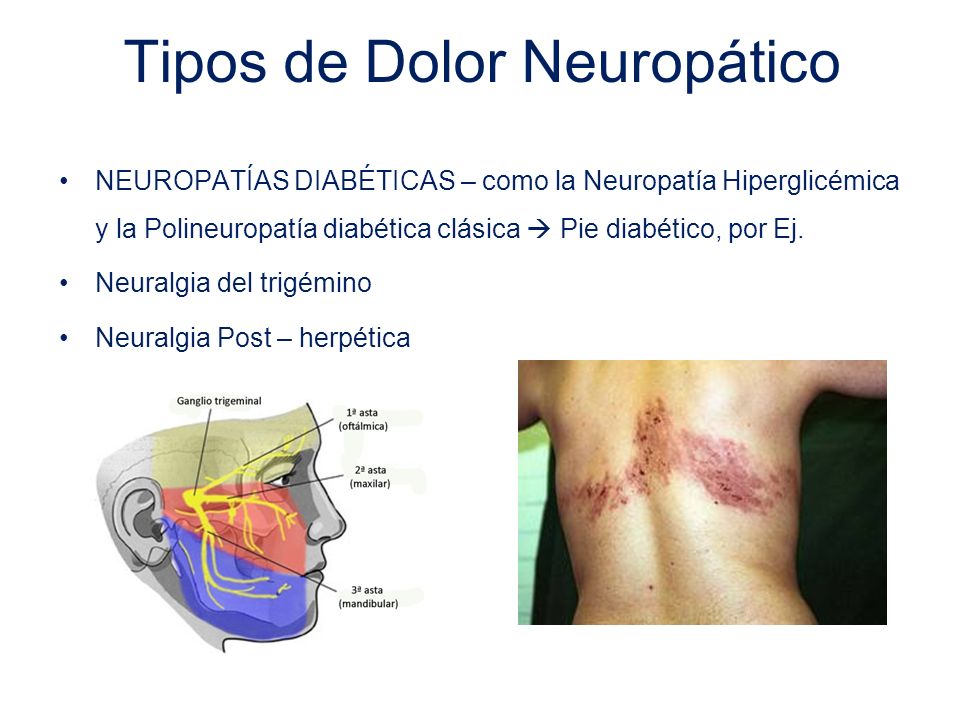 Tipos de Dolor Neuropático