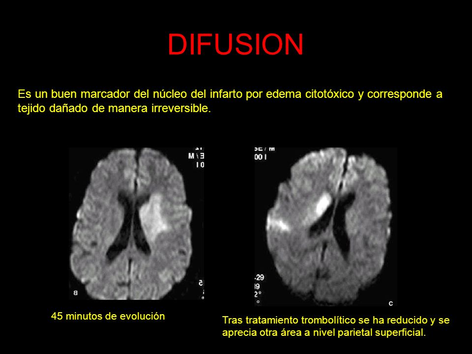 DIFUSION Es un buen marcador del núcleo del infarto por edema citotóxico y corresponde a tejido dañado de manera irreversible.