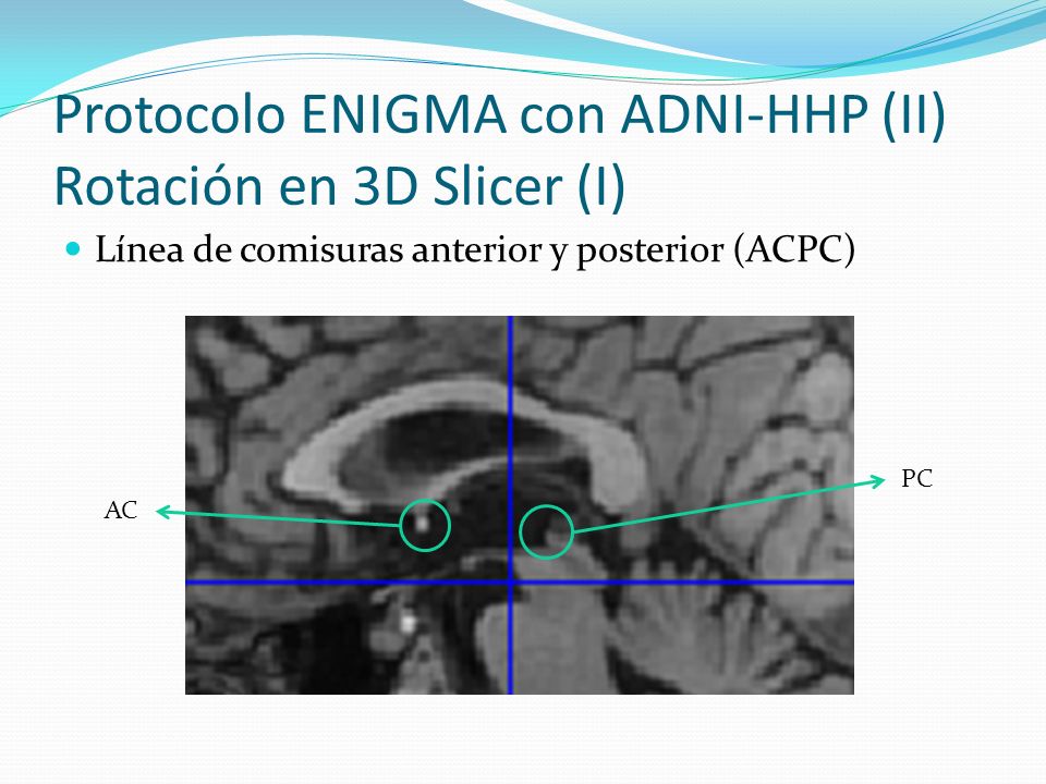 Protocolo ENIGMA con ADNI-HHP (II) Rotación en 3D Slicer (I)