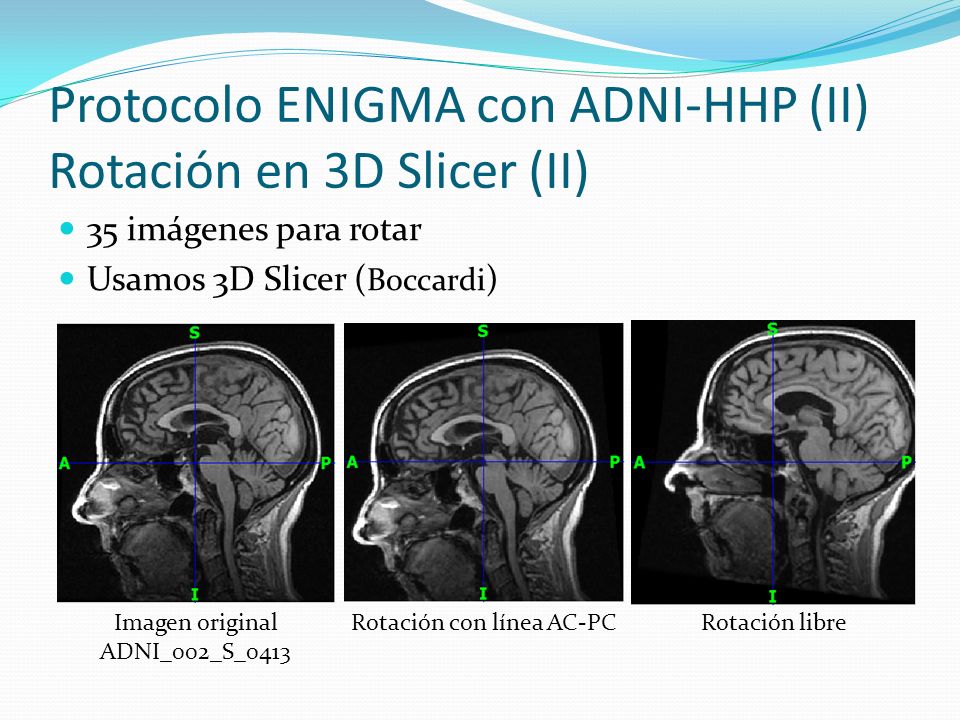 Protocolo ENIGMA con ADNI-HHP (II) Rotación en 3D Slicer (II)