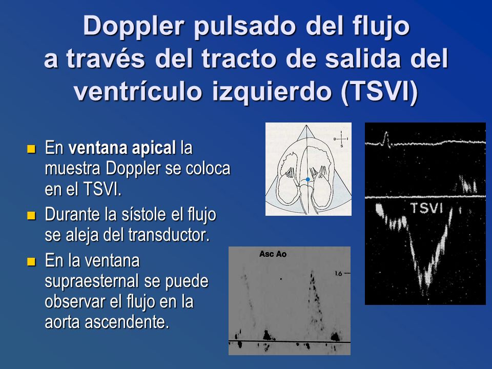Doppler pulsado del flujo a través del tracto de salida del ventrículo izquierdo (TSVI)