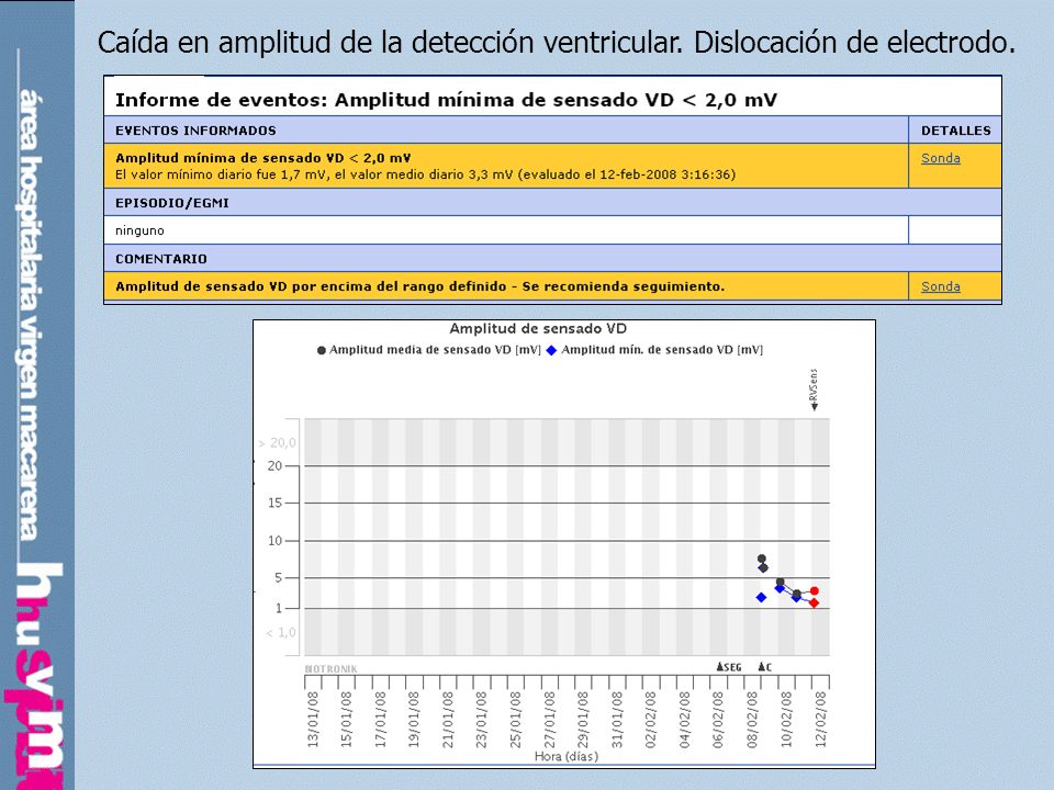 Caída en amplitud de la detección ventricular. Dislocación de electrodo.