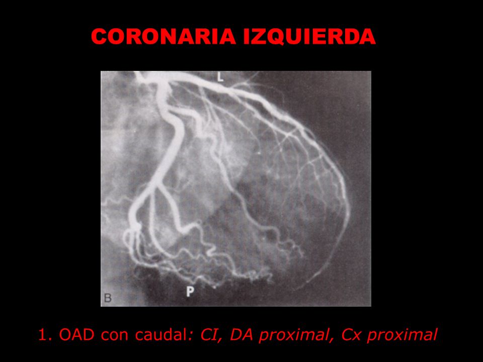CORONARIA IZQUIERDA 1. OAD con caudal: CI, DA proximal, Cx proximal