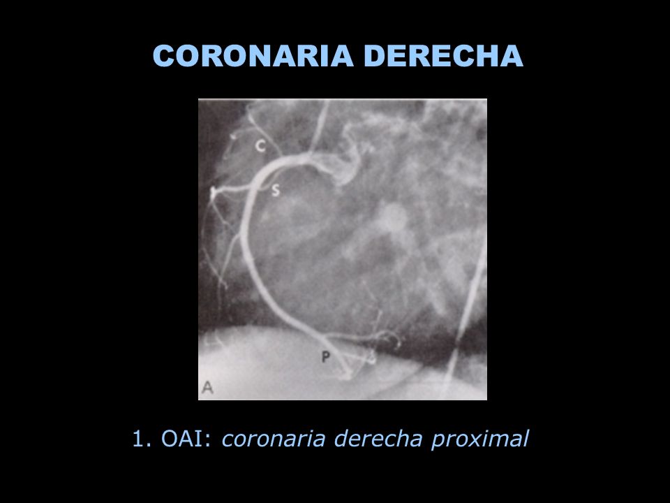 CORONARIA DERECHA 1. OAI: coronaria derecha proximal