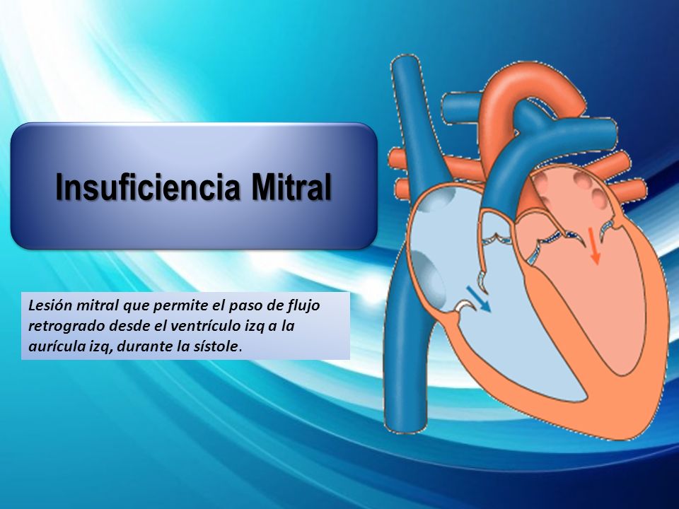 Insuficiencia Mitral Lesión mitral que permite el paso de flujo retrogrado desde el ventrículo izq a la aurícula izq, durante la sístole.