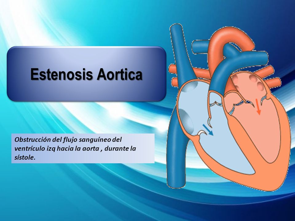Estenosis Aortica Obstrucción del flujo sanguíneo del ventrículo izq hacia la aorta , durante la sístole.