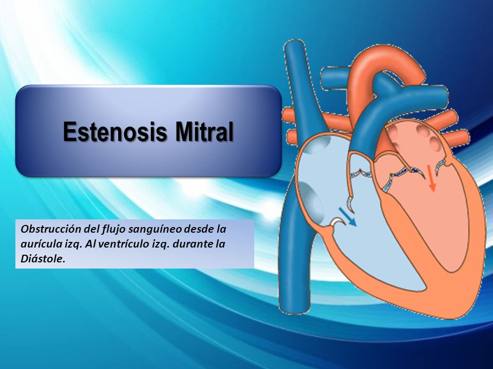 Estenosis Mitral Obstrucción del flujo sanguíneo desde la aurícula izq.