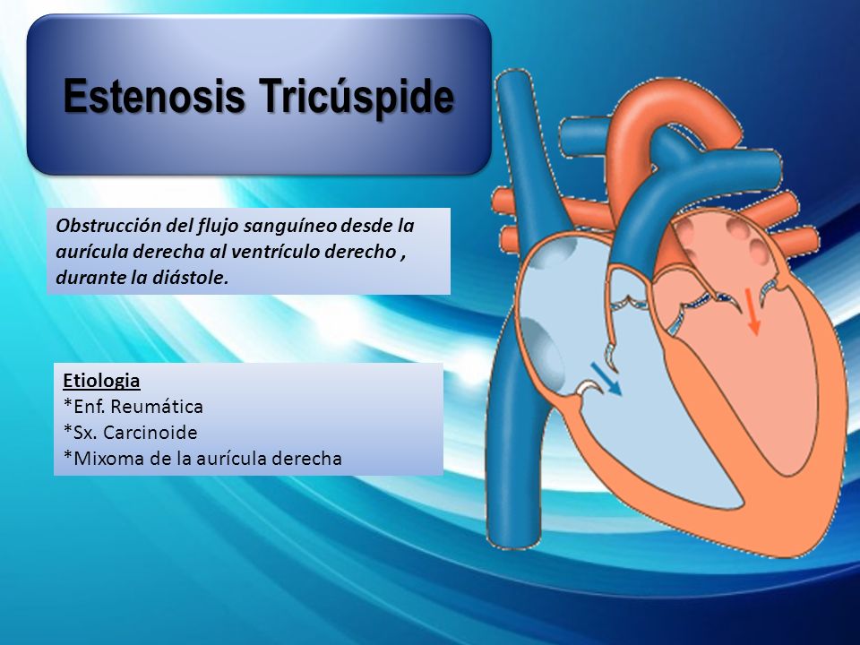 Estenosis Tricúspide Obstrucción del flujo sanguíneo desde la aurícula derecha al ventrículo derecho , durante la diástole.