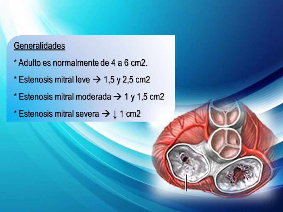 Generalidades * Adulto es normalmente de 4 a 6 cm2. * Estenosis mitral leve  1,5 y 2,5 cm2. * Estenosis mitral moderada  1 y 1,5 cm2.