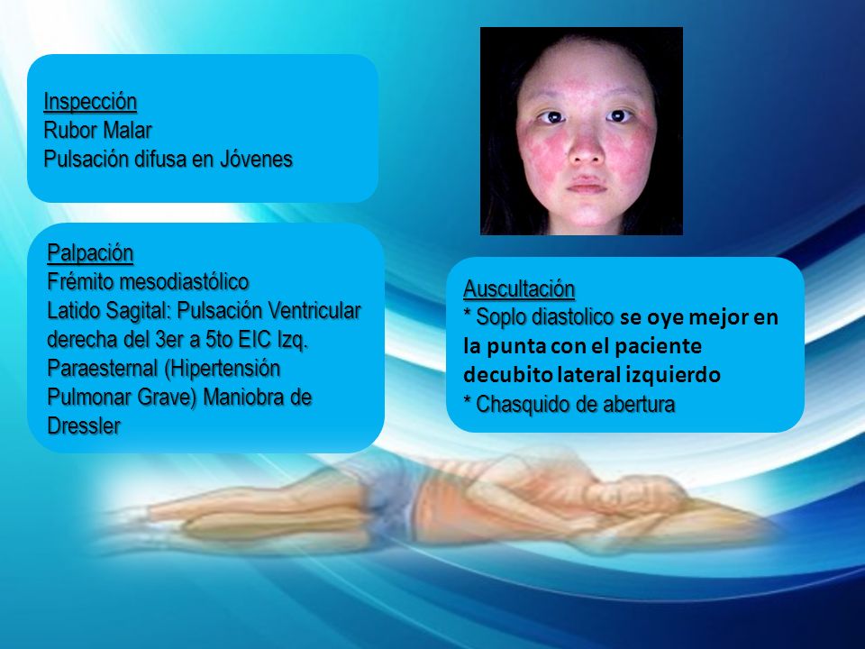 Inspección Rubor Malar. Pulsación difusa en Jóvenes. Palpación. Frémito mesodiastólico.
